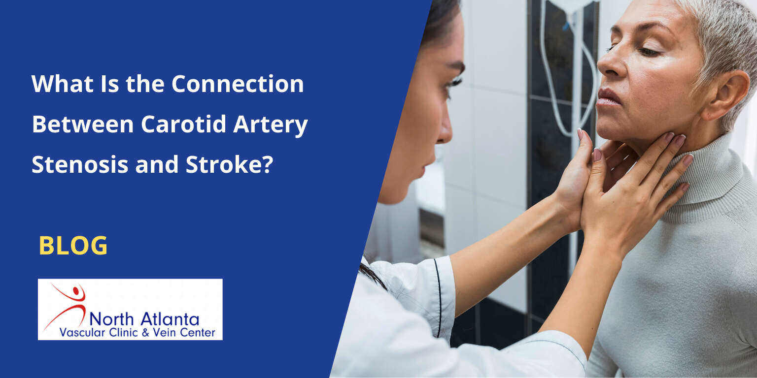 What Is the Connection Between Carotid Artery Stenosis and Stroke?