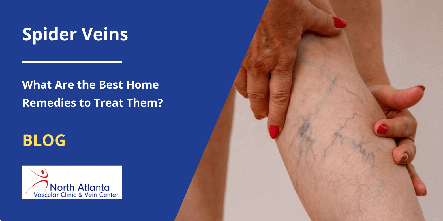 Getting Rid of Varicose Veins: Treatment and Prevention – The