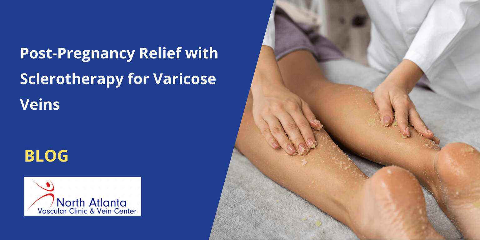 Post-Pregnancy Relief with Sclerotherapy for Varicose Veins